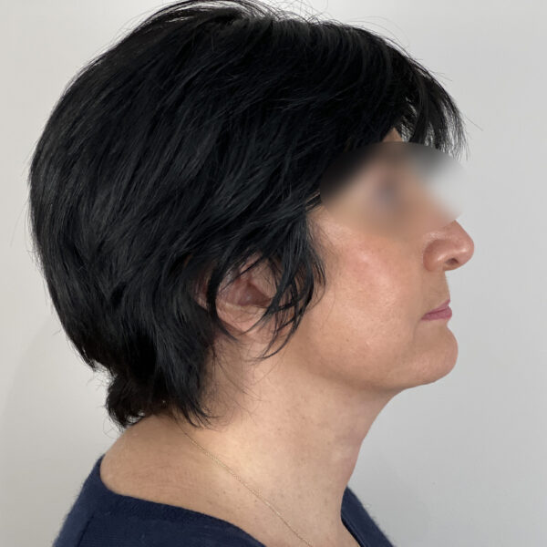 Lifting Docteur Alexandre Vairinho Paris Après Résultat 100