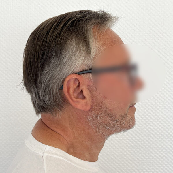 Lifting Docteur Alexandre Vairinho Paris Après Résultat Homme 100