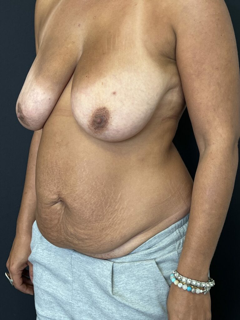 Mommy Makeover Docteur Alexandre Vairinho Paris Avant 1002