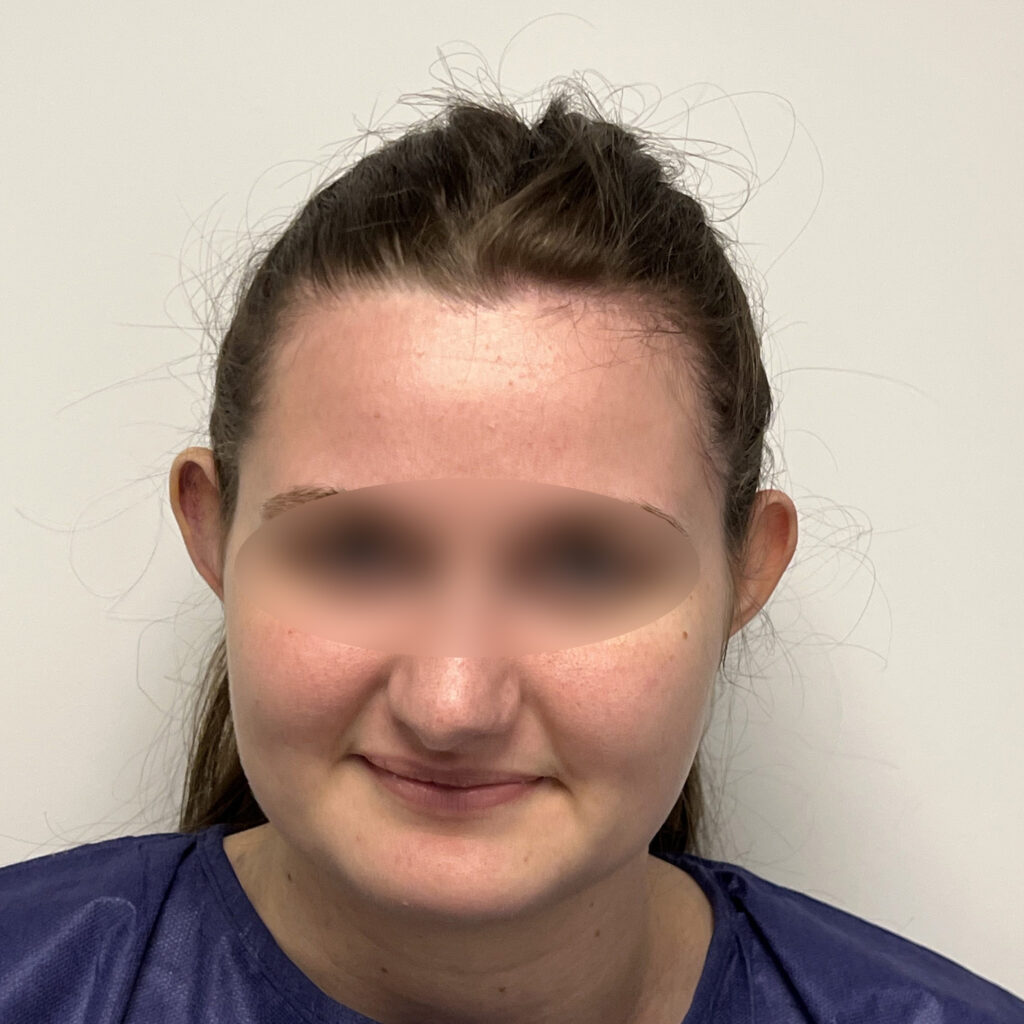 Otoplastie Docteur Alexandre Vairinho Paris Avant 100