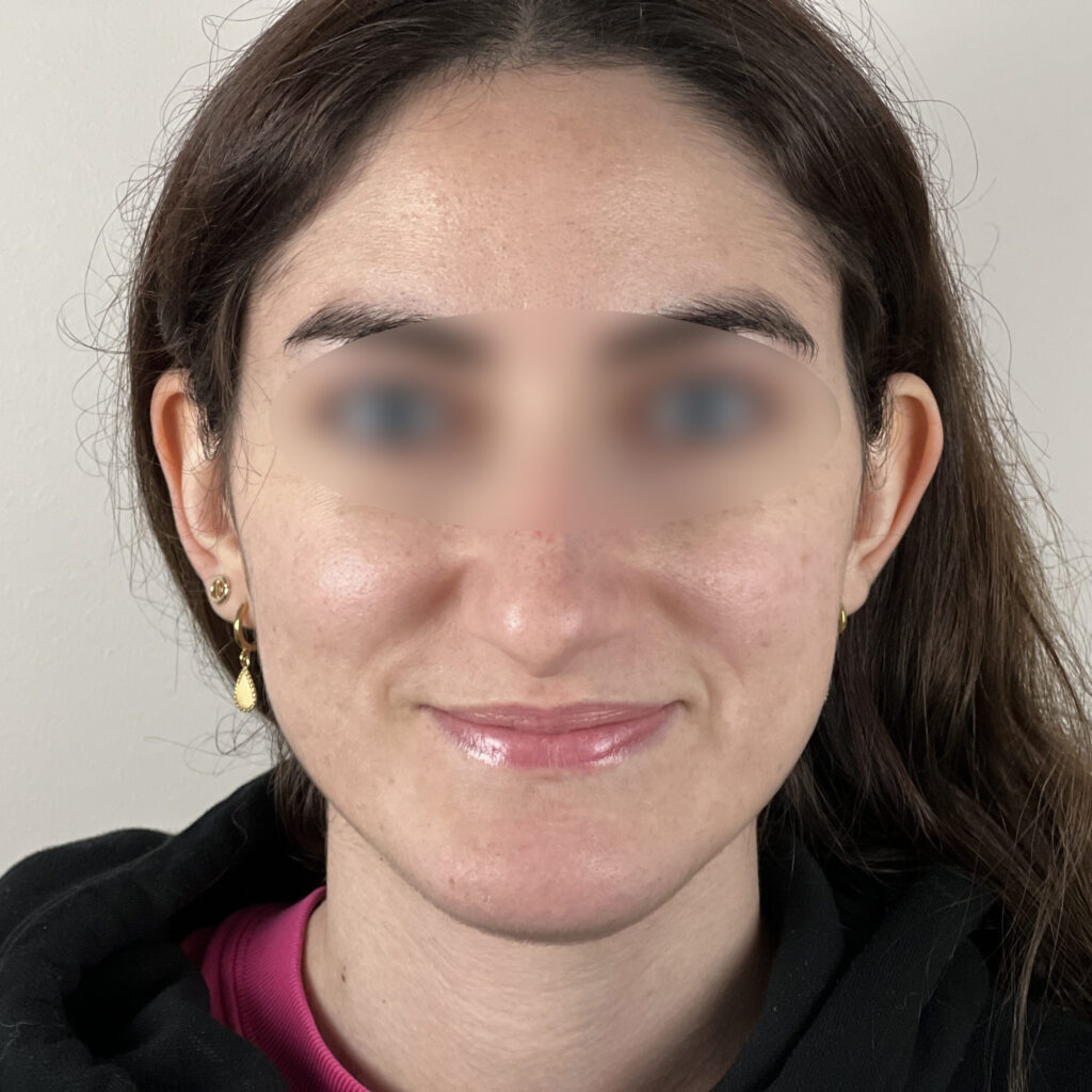 Otoplastie Docteur Alexandre Vairinho Paris Avant 1001