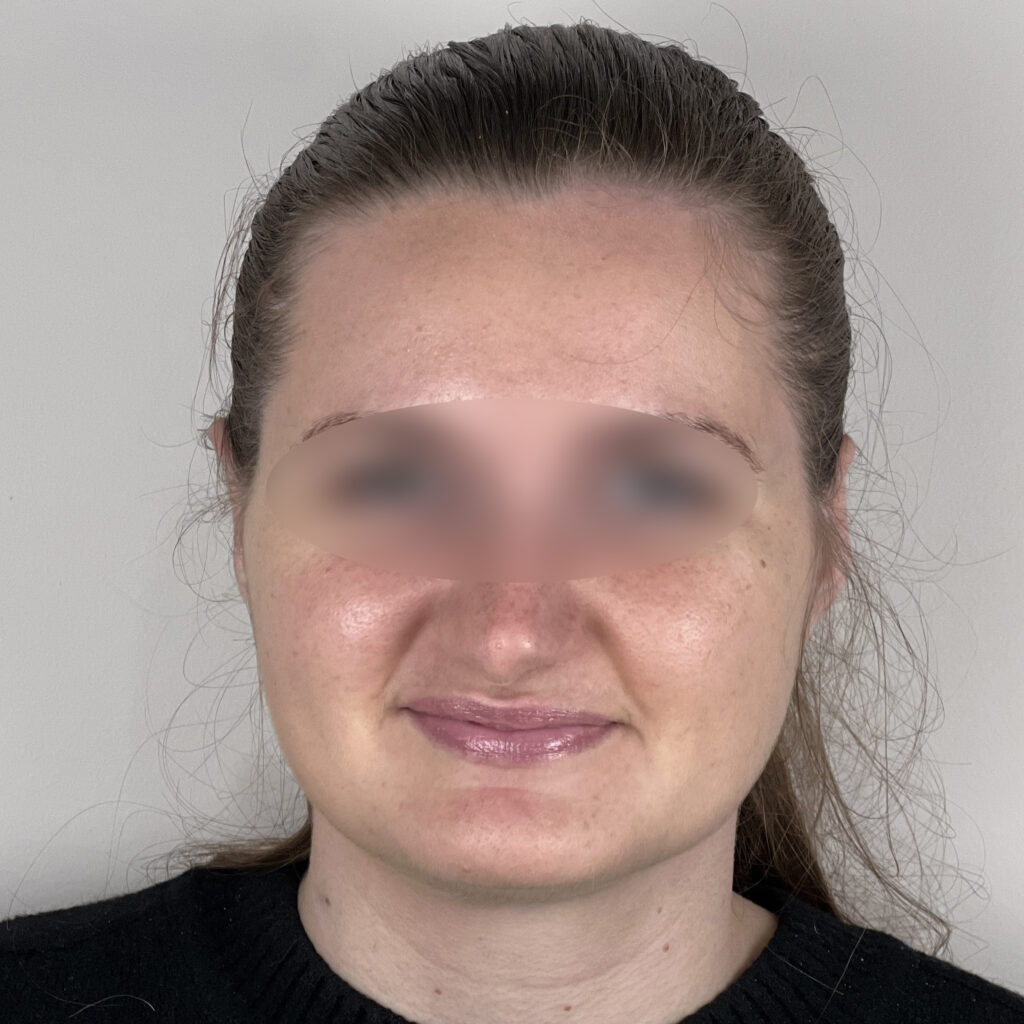 Otoplastie Docteur Alexandre Vairinho Paris Résultat Après 1000