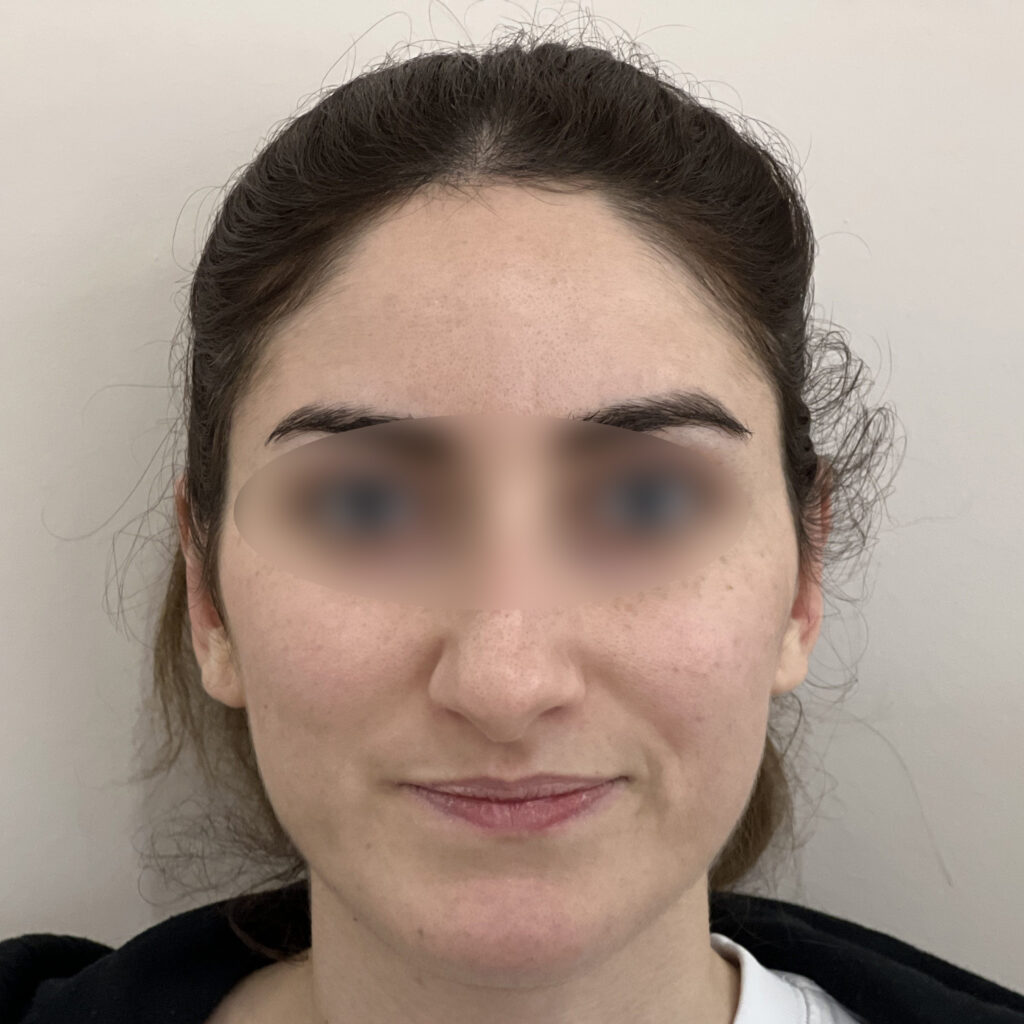 Otoplastie Docteur Alexandre Vairinho Paris Résultat Après 1001