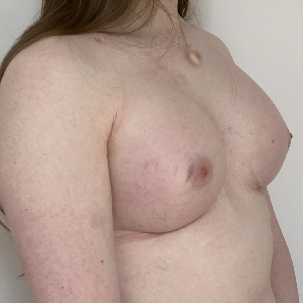 Prothèses mammaires femme trans Docteur Alexandre Vairinho Paris Après Résultat 1000