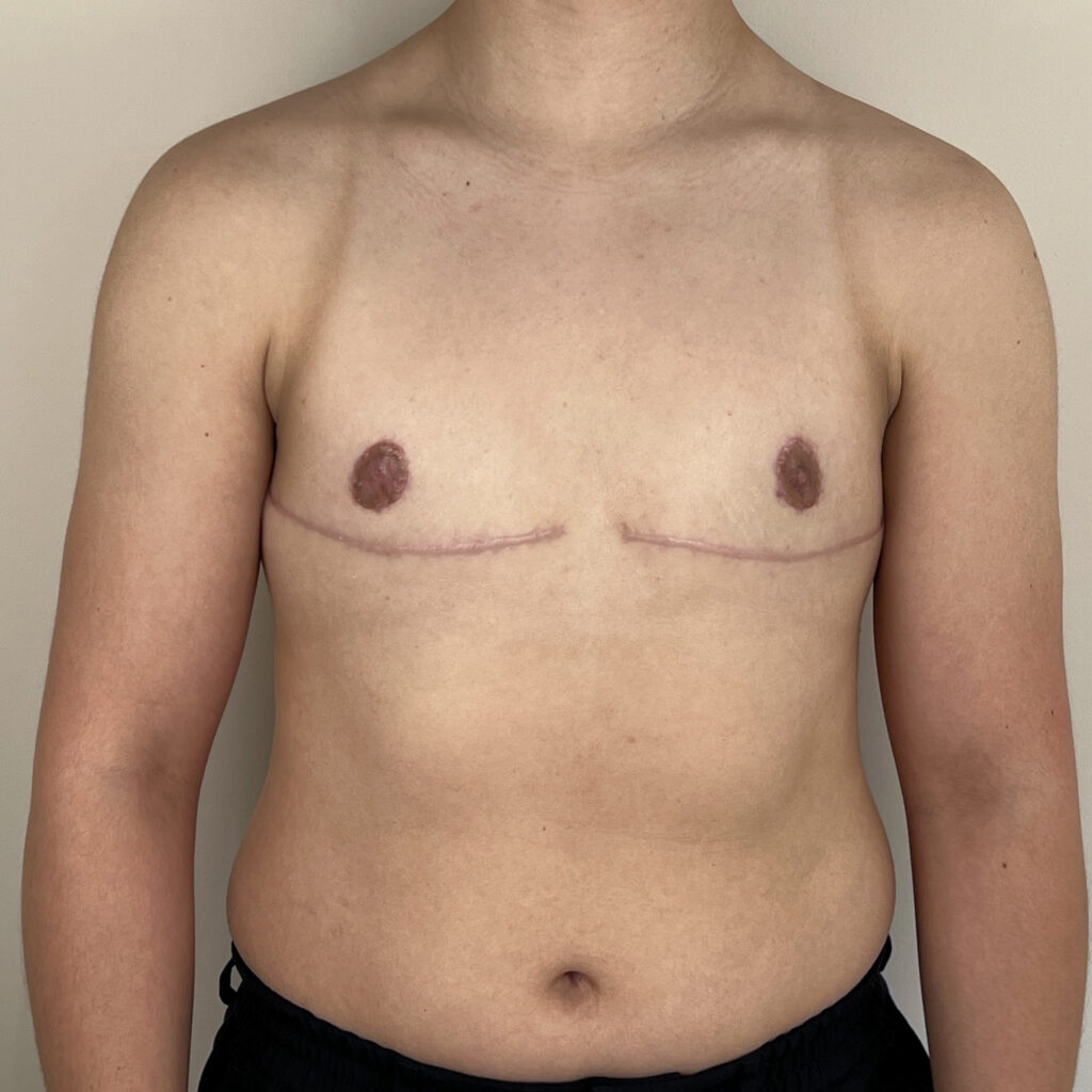 Torsoplastie homme trans Docteur Alexandre Vairinho Paris Après Résultat 10002