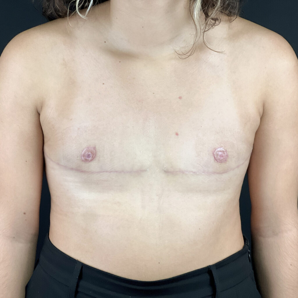 Torsoplastie homme trans Docteur Alexandre Vairinho Paris Après Résultat 10003