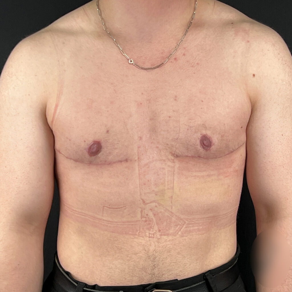 Torsoplastie homme trans Docteur Alexandre Vairinho Paris Après Résultat 10005