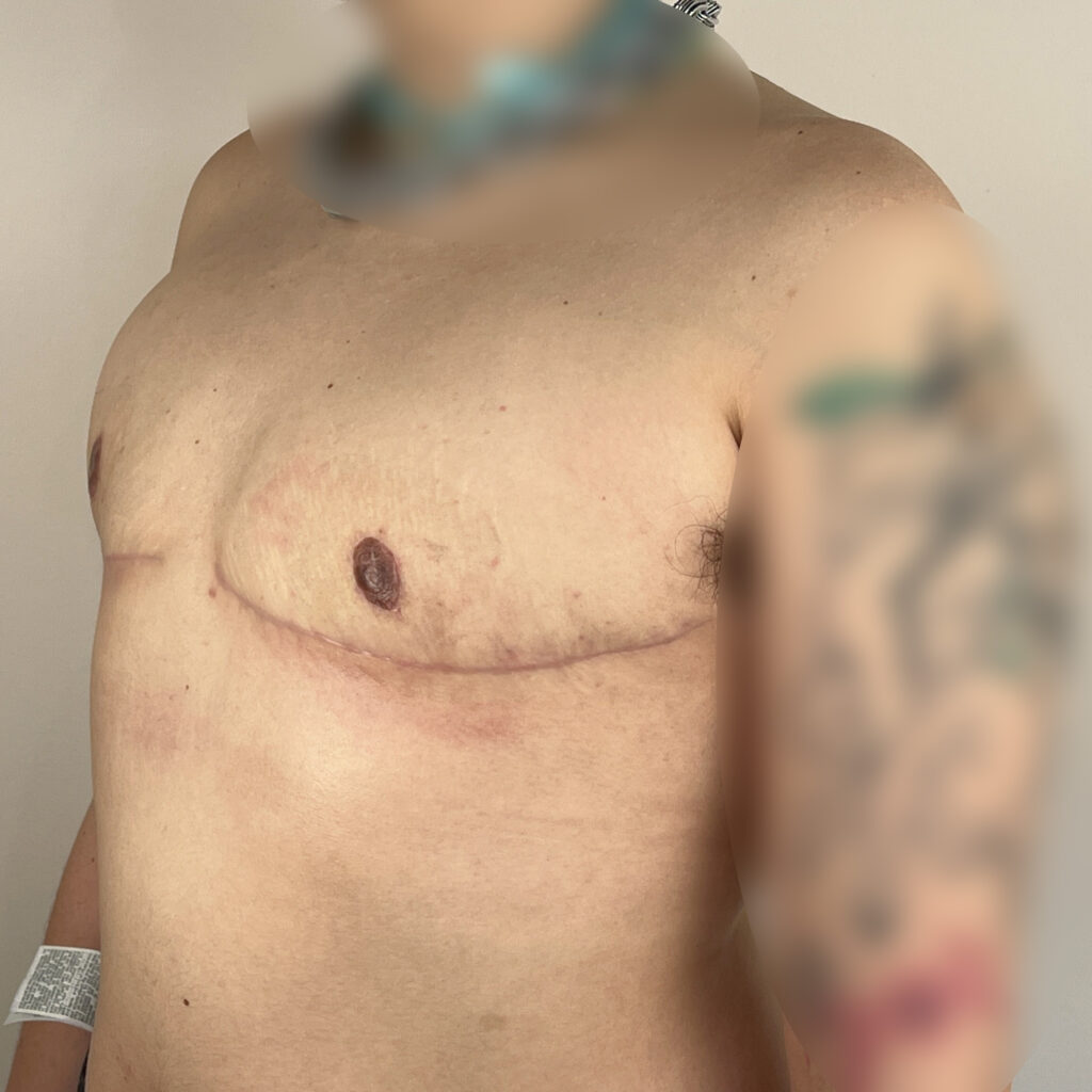 Torsoplastie homme trans Docteur Alexandre Vairinho Paris Après Résultat 10006