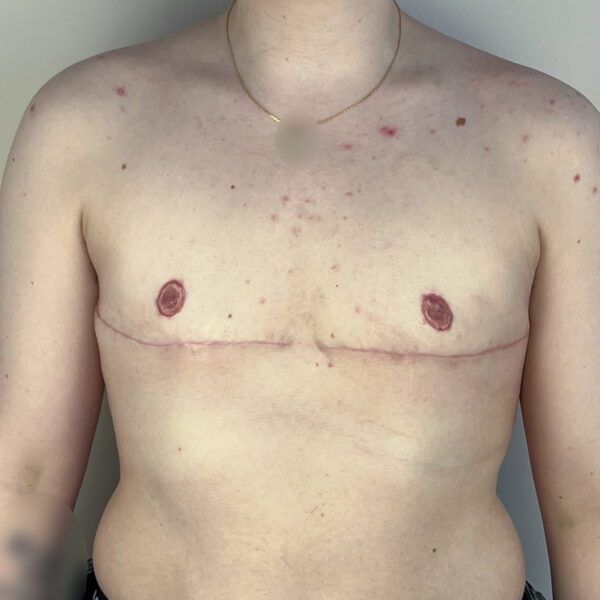 Torsoplastie homme trans Docteur Alexandre Vairinho Paris Après Résultat 10007