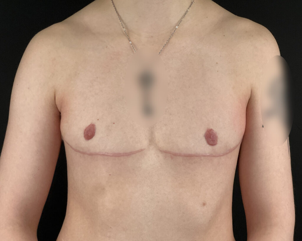 Torsoplastie homme trans Docteur Alexandre Vairinho Paris Après Résultat 10008