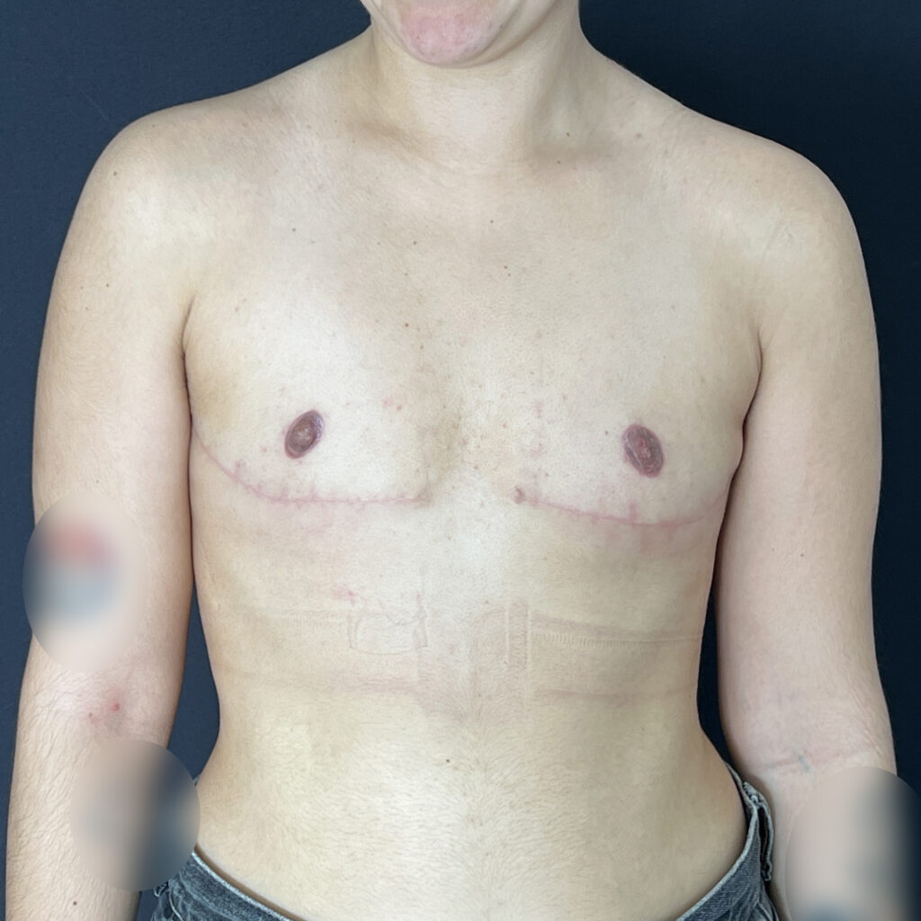 Torsoplastie homme trans Docteur Alexandre Vairinho Paris Après Résultat 10009