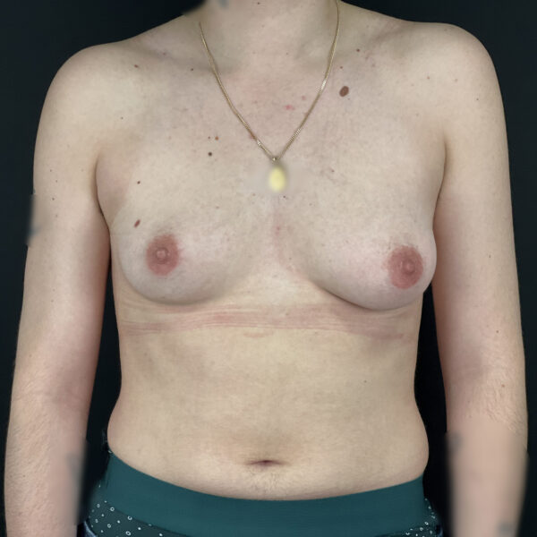 Torsoplastie homme trans Docteur Alexandre Vairinho Paris Avant 1000