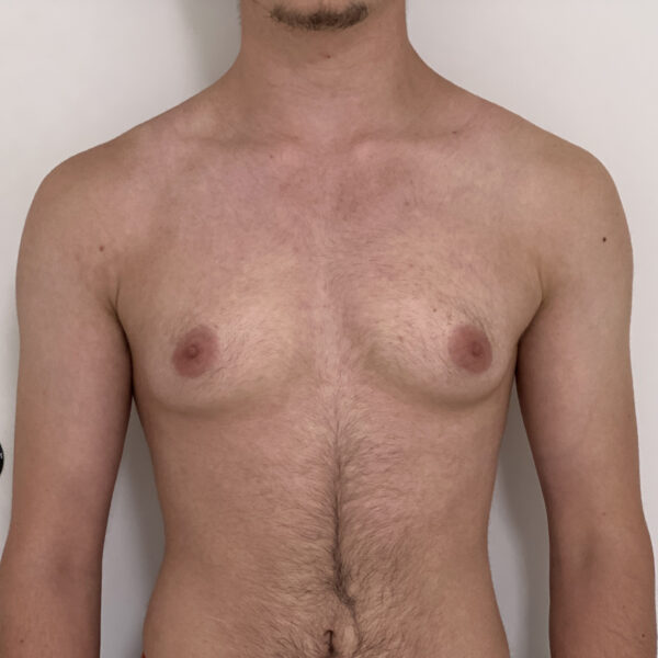 Torsoplastie homme trans Docteur Alexandre Vairinho Paris Avant 10004