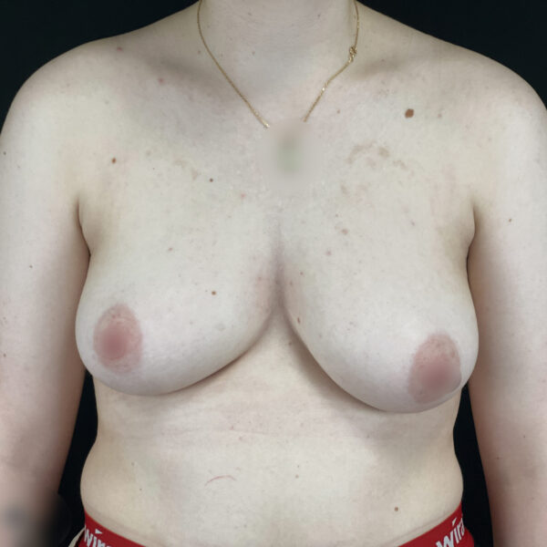 Torsoplastie homme trans Docteur Alexandre Vairinho Paris Avant 10007