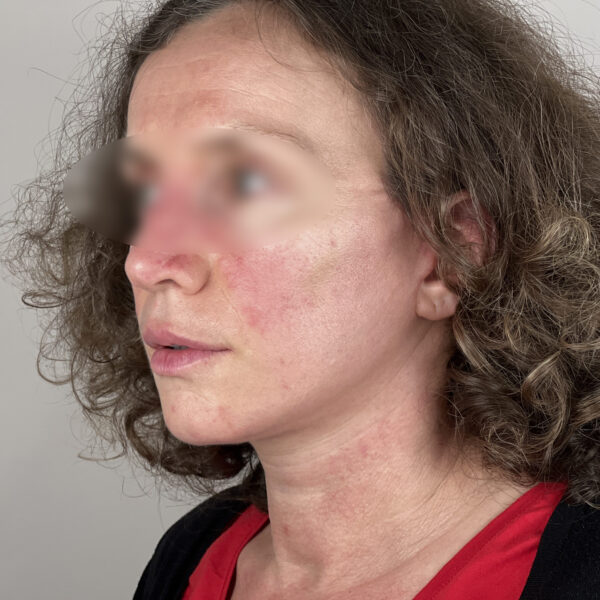 Lifting Docteur Alexandre Vairinho Paris Chirurgien Après Résultat 201