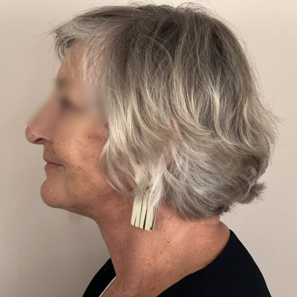 Lifting Docteur Alexandre Vairinho Paris Chirurgien Après Résultat 202