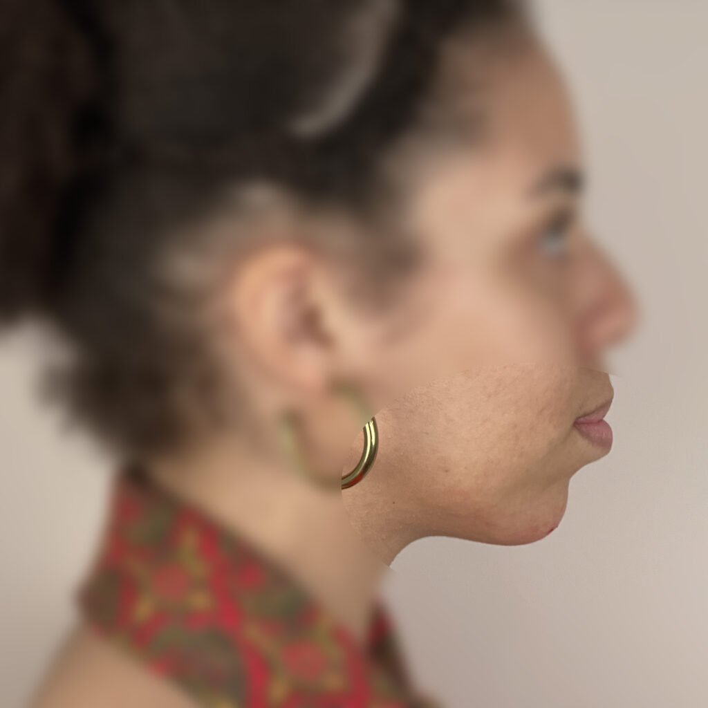 Acide hyaluronique Docteur Alexandre Vairinho Paris Après Résultat 201