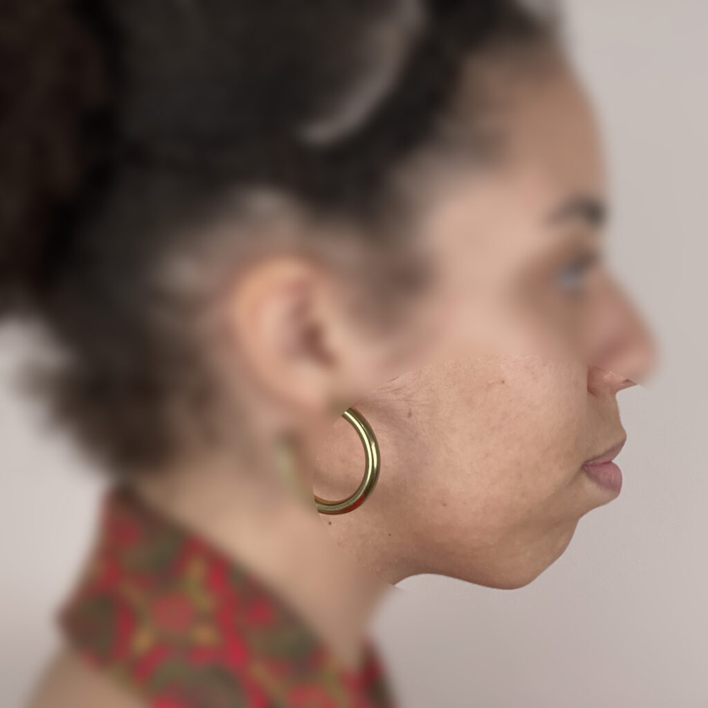 Acide hyaluronique Docteur Alexandre Vairinho Paris Avant 201