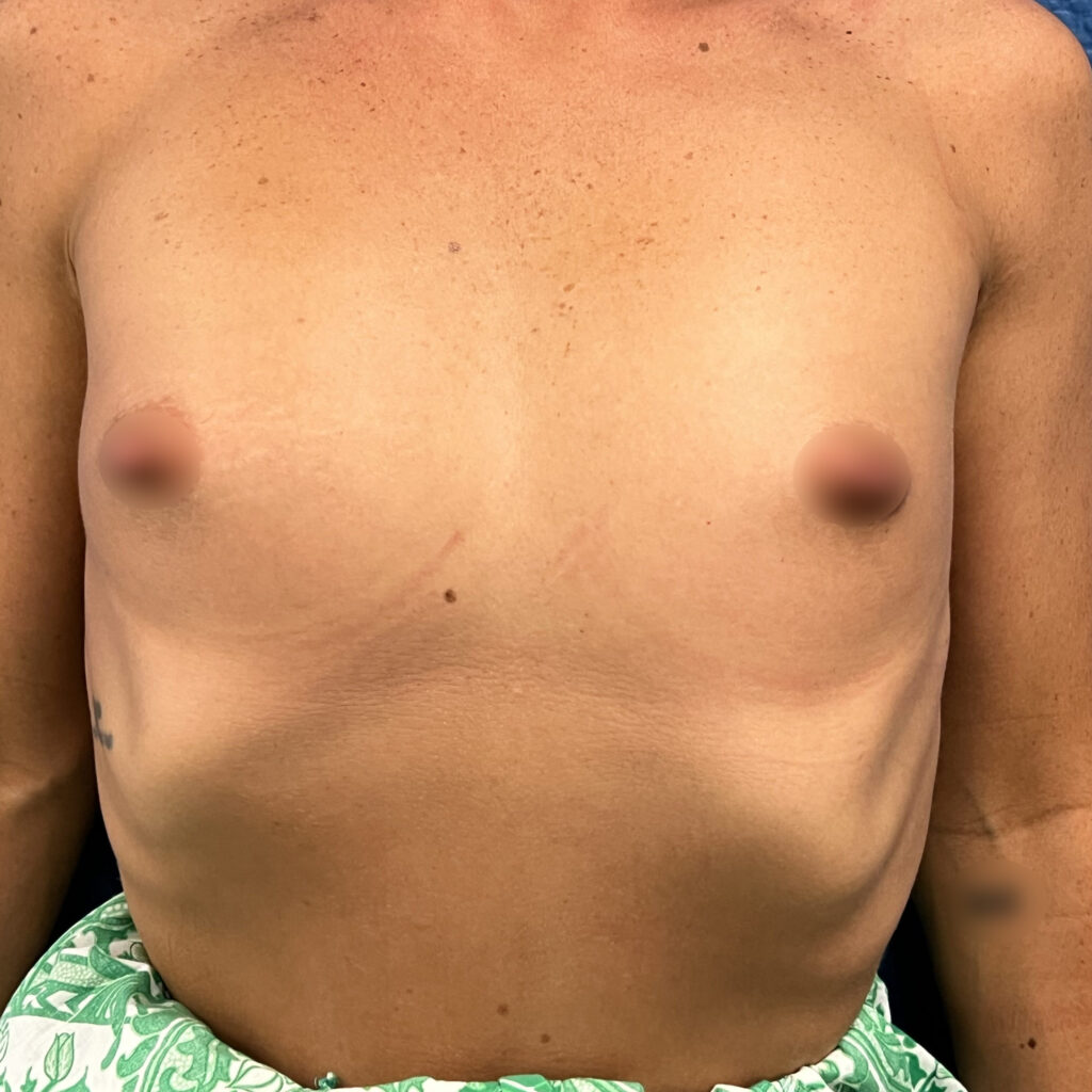 Augmentation Mammaire Docteur Alexandre Vairinho Paris Avant 204