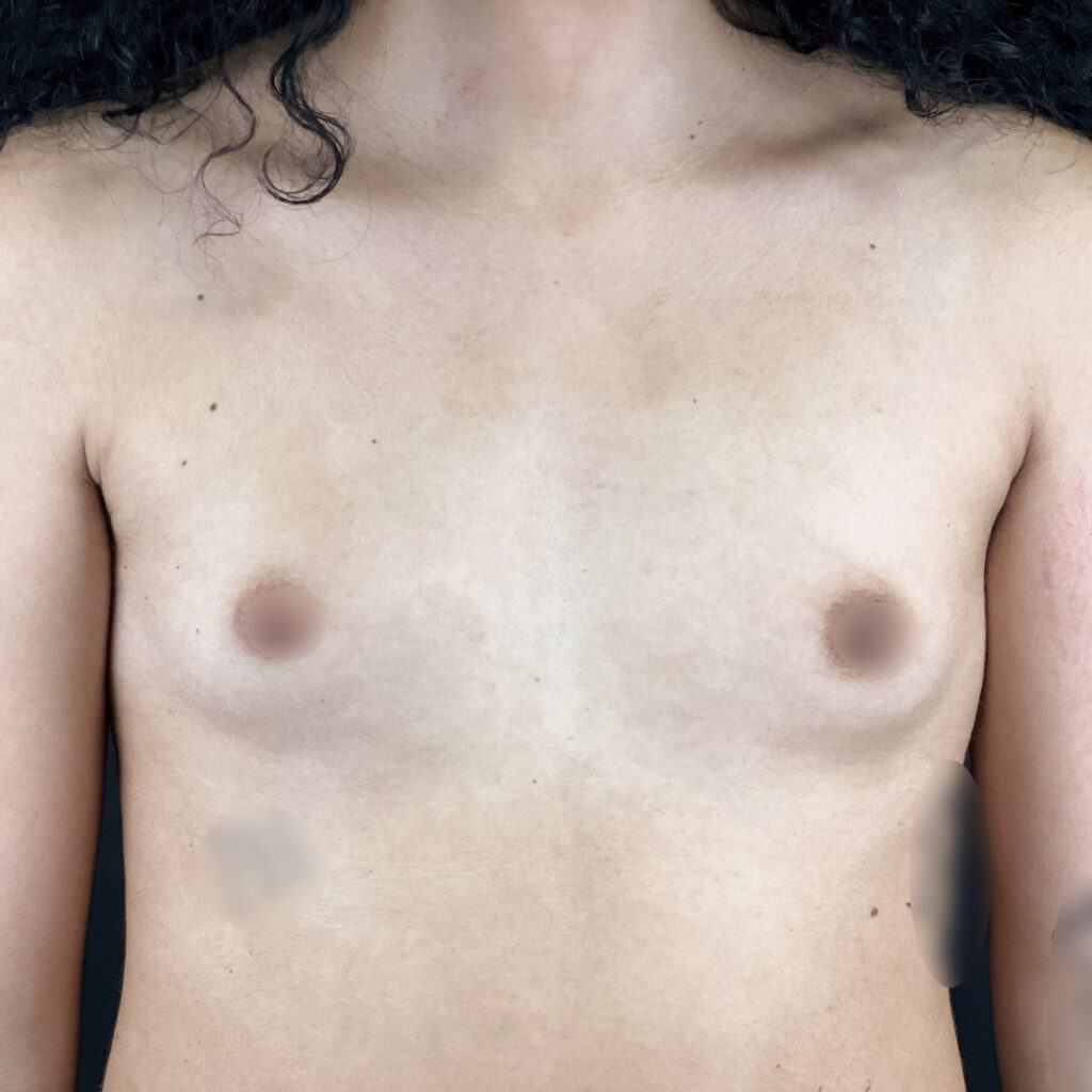 Augmentation Mammaire Docteur Alexandre Vairinho Paris Avant 208
