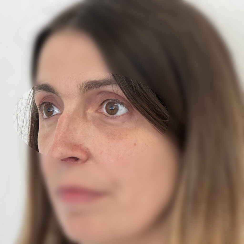 Blépharoplastie Yeux Regard Docteur Alexandre Vairinho Paris Chirurgien Après Résultat 201