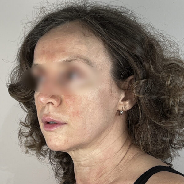 Lifting Docteur Alexandre Vairinho Paris Chirurgien Avant 201