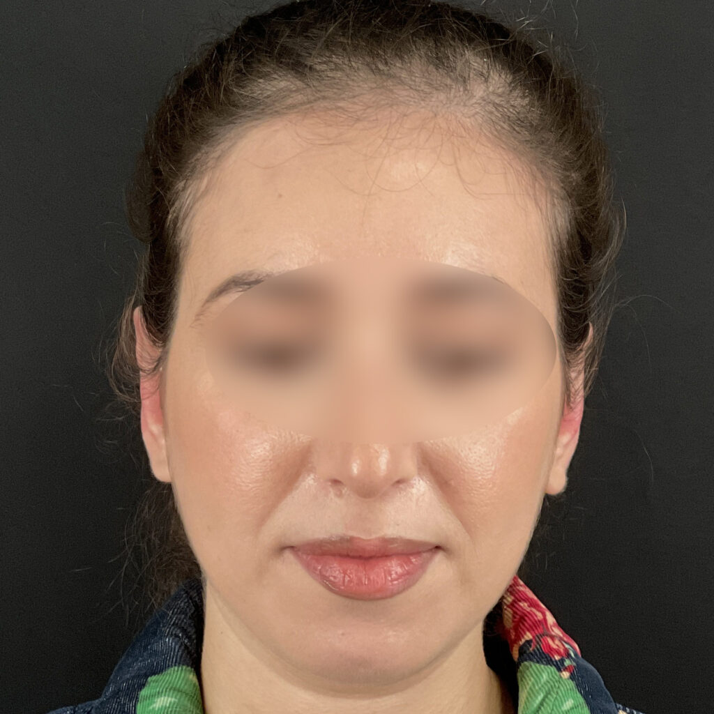 Otoplastie des Oreilles Docteur Alexandre Vairinho Paris Chirurgien Après Résultat 201