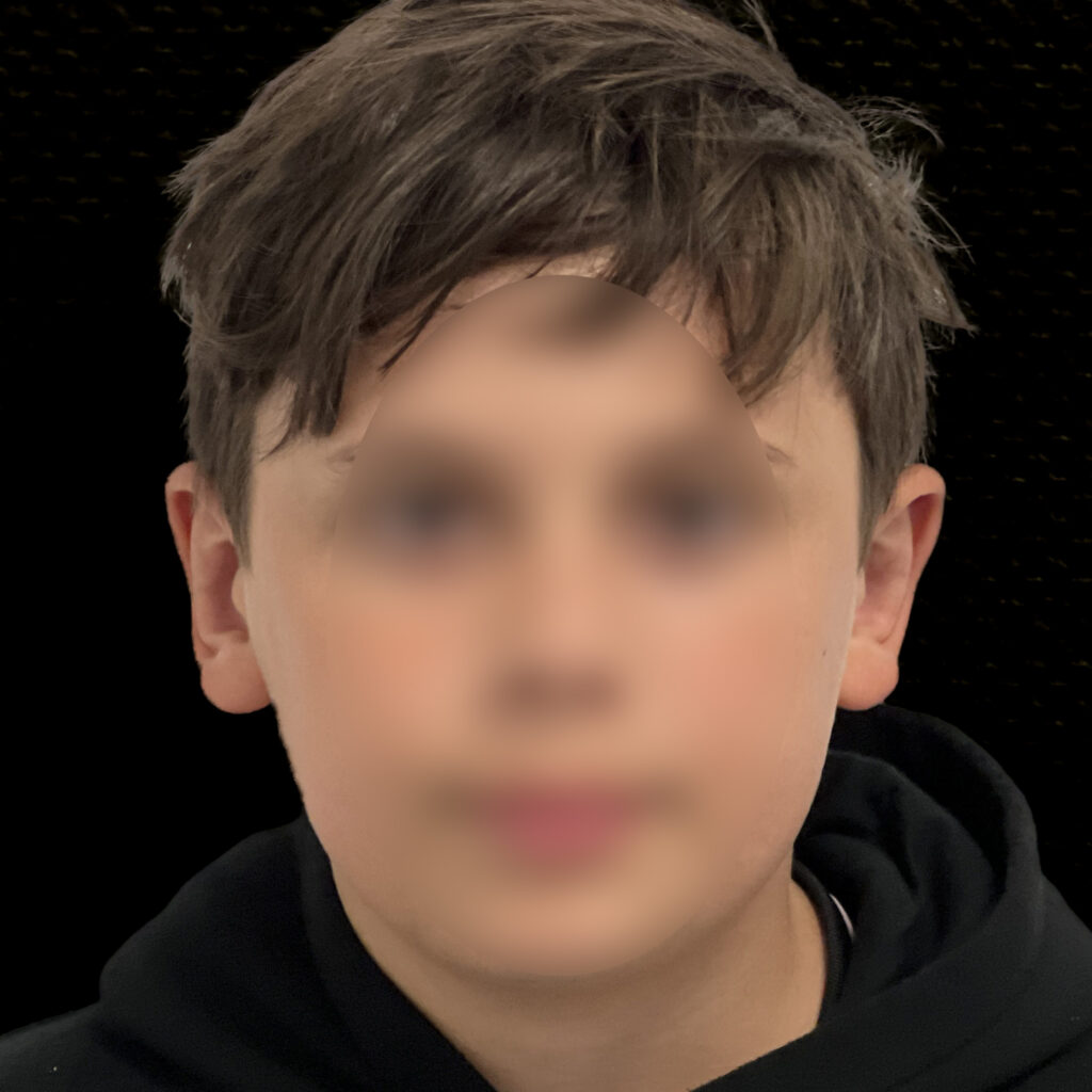 Otoplastie des Oreilles Docteur Alexandre Vairinho Paris Chirurgien Après Résultat 202