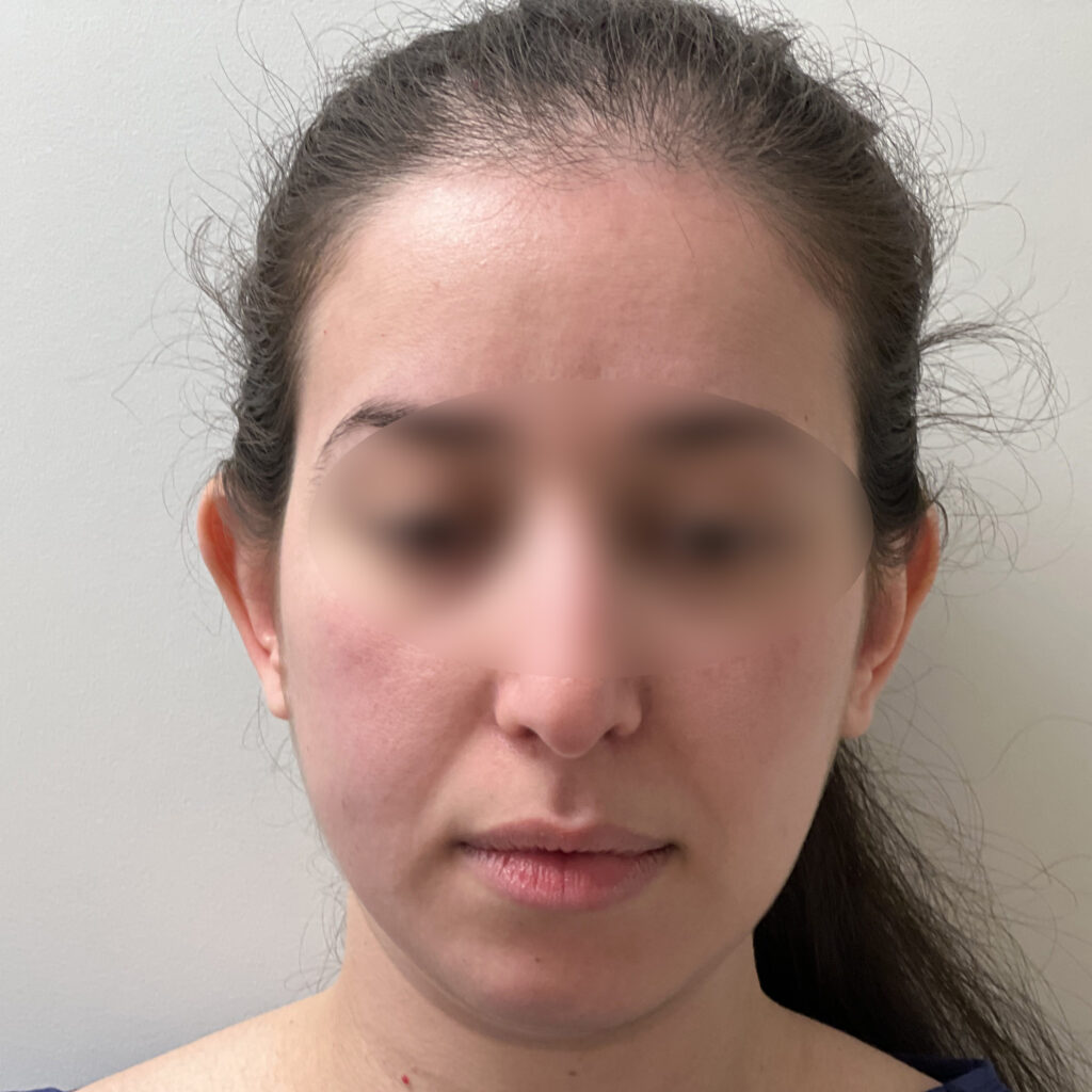 Otoplastie des Oreilles Docteur Alexandre Vairinho Paris Chirurgien Avant 201