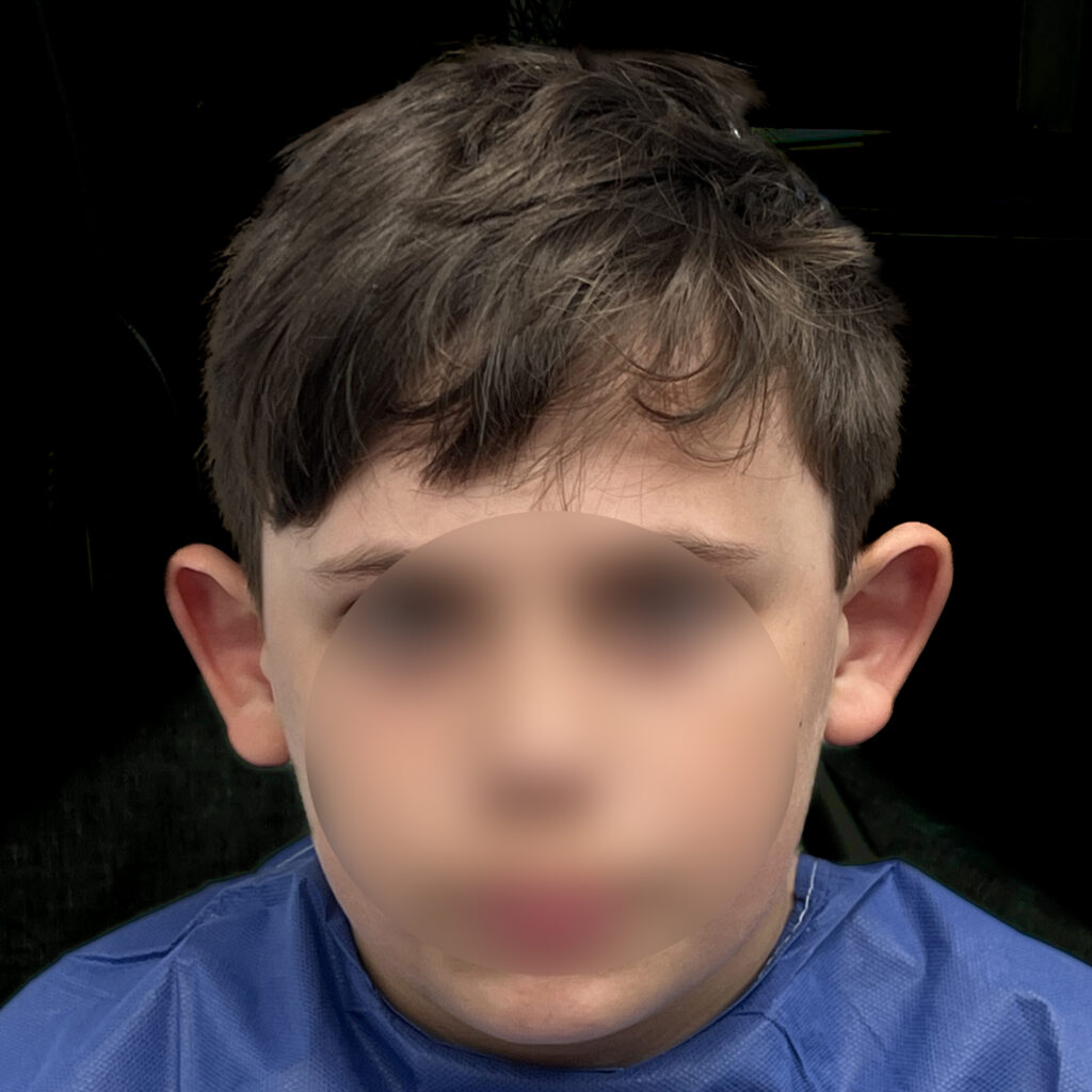 Otoplastie des Oreilles Docteur Alexandre Vairinho Paris Chirurgien Avant 202