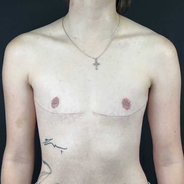 Torsoplastie Homme Trans Docteur Alexandre Vairinho Paris Après Résultat 201