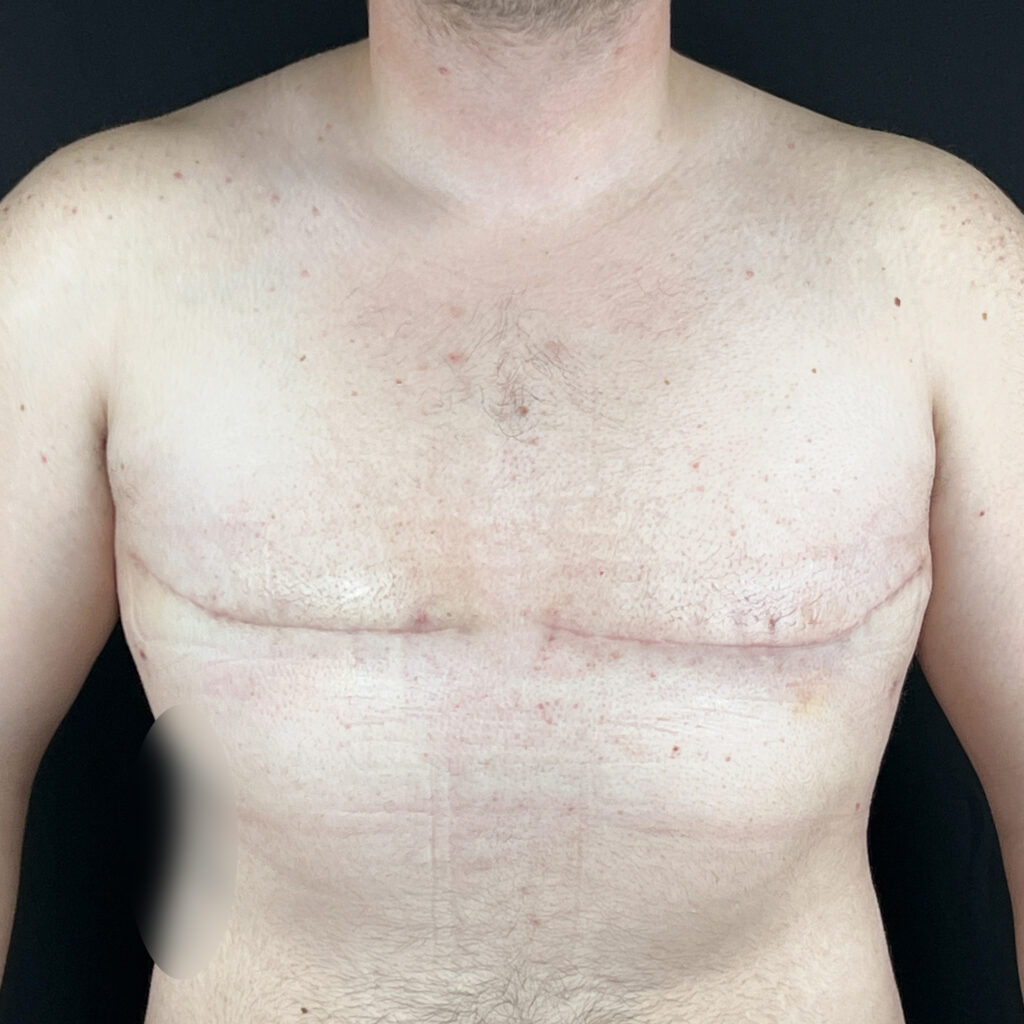 Torsoplastie Homme Trans Docteur Alexandre Vairinho Paris Après Résultat 202