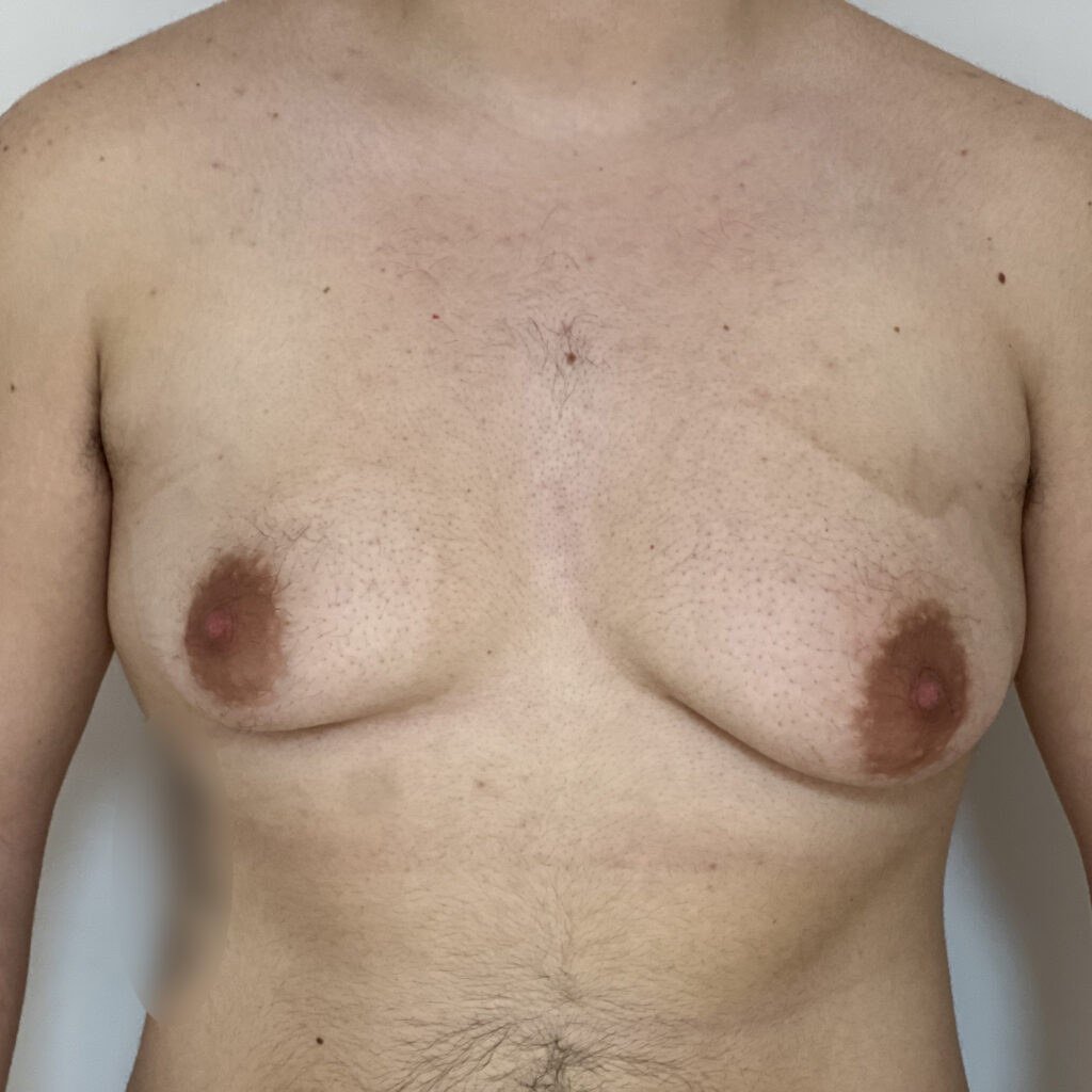 Torsoplastie Homme Trans Docteur Alexandre Vairinho Paris Avant 202