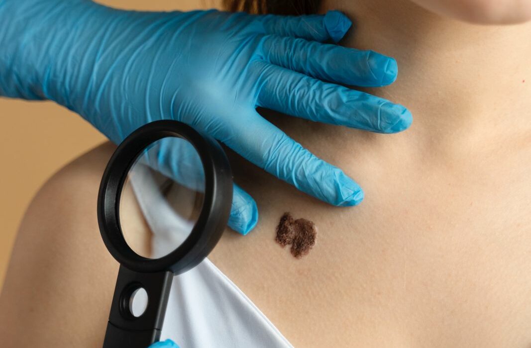 clavicule femme avec un cancer de la peau et une loupe